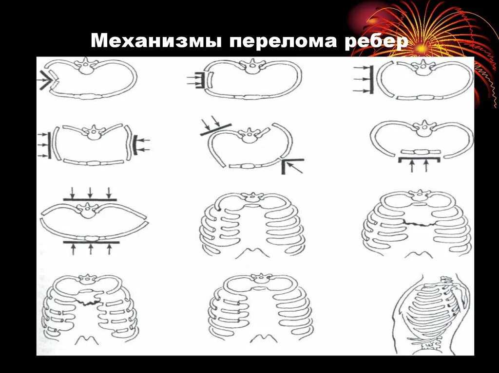 Переломы ребер классификация механизм травмы. Непрямые переломы ребер. Механизм перелома ребер. Повреждение ребер классификация.