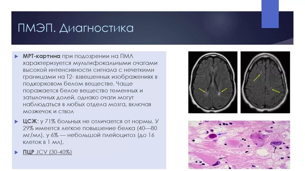 Мультифокальная лейкоэнцефалопатия мрт. Прогрессирующая мультифокальная лейкоэнцефалопатия кт. Лейкоэнцефалопатия головного мозга кт. Лейкоэнцефалопатия головного мозга мрт. Многоочаговое поражение головного мозга