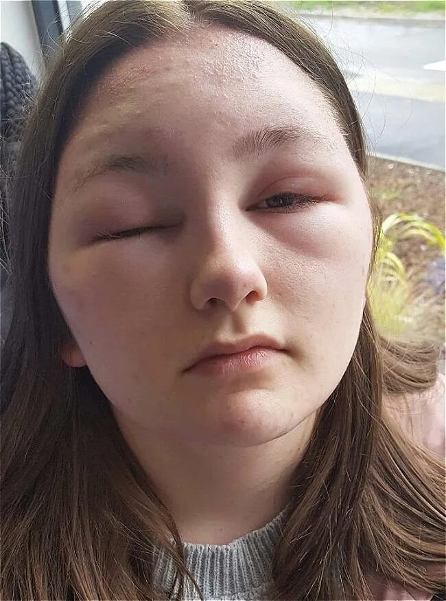 отек лица у девушки