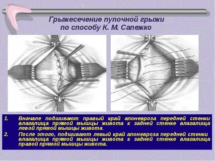 Пупочная грыжа методы операции