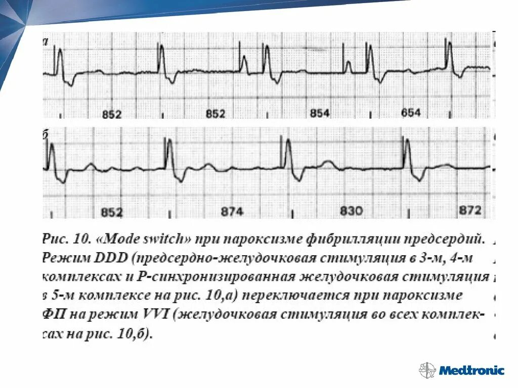 Электрофизиологическое исследование сердца (эфи). Экг с кардиостимулятором расшифровка. Стимуляция предсердия. Однокамерный кардиостимулятор сердца. Стимуляция предсердия.
