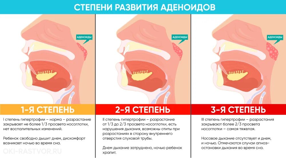 Аденоиды 2 степени у ребенка. Симптомы при аденоидов к детей. Аденоидит симптомы у ребенка 3 года. Степени увеличения аденоидов.