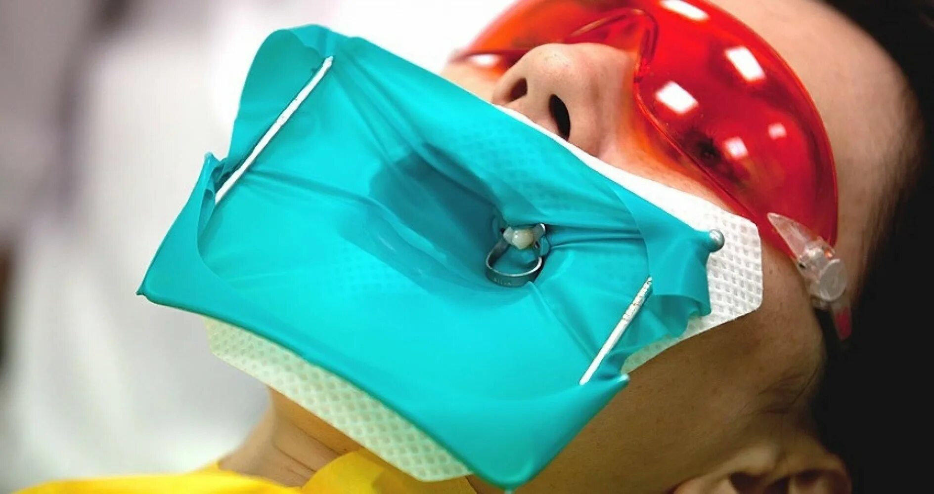 Коффердам (стоматология). Изоляция зубов коффердам. Изоляция зуба коффердамом. Коффердам (стоматология). Коффердам оптидам раббердам.