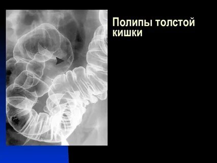 Полипоз толстой