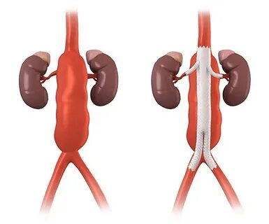 Abdominal aortic aneurysm