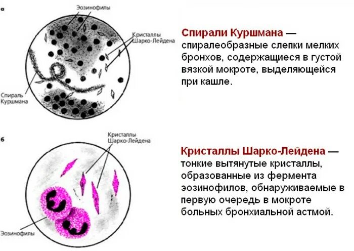 Спирали Куршмана и Кристаллы Шарко-Лейдена. Спирали Куршмана и Кристаллы Шарко-Лейдена в мокроте определяются. Спирали Куршмана и Кристаллы Шарко-Лейдена в мокроте. Кристаллы Шарко-Лейдена в мокроте.