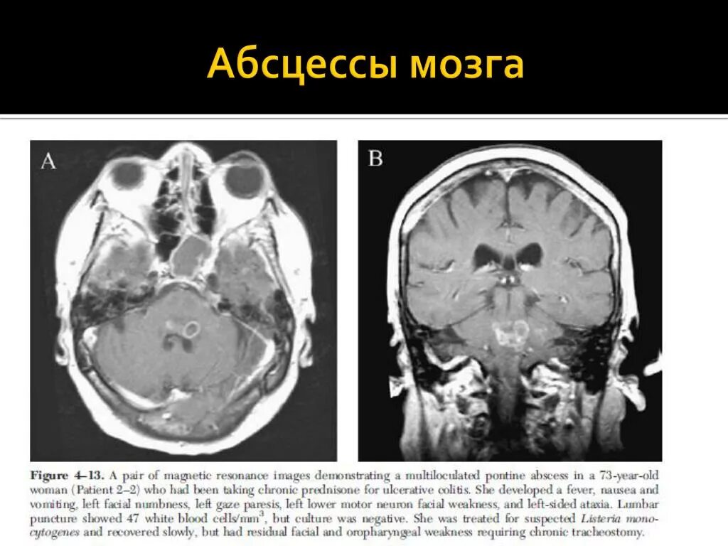 Абсцесс мозга