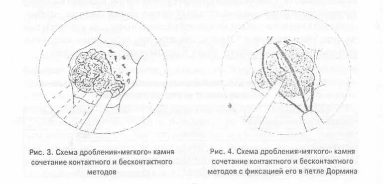 Как дробят камни в мочеточнике. Дробление камней в мочеточнике лазером. Дробление камня через мочеточник. Дробление камней в мочеточнике ультразвуком. Бесконтактное дробление камней.