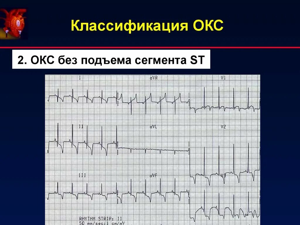 Экг подъем. Острый коронарный синдром ЭКГ. Инфаркт миокарда с подъемом сегмента St ЭКГ. Окс инфаркт ЭКГ. ЭКГ инфаркт миокарда без подъема St.