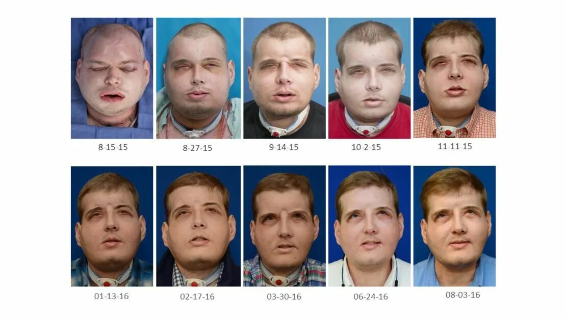 Как выглядит пересаженное лицо ПОМОЩЬ ГРАЖДАНАМ КЫРГЫЗСТАНА Группа на  Вступай, читай, общайся в Однокласс
