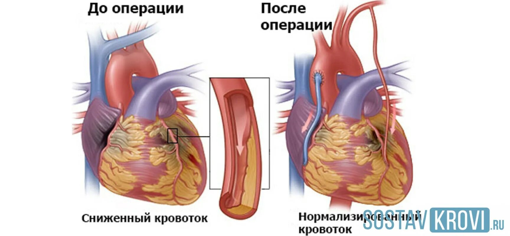 Шунтирование коронарных артерий. Аортокоронарное шунтирование хирургия. Маммарно коронарное шунтирование. Коронарное шунтирование сосудов сердца.