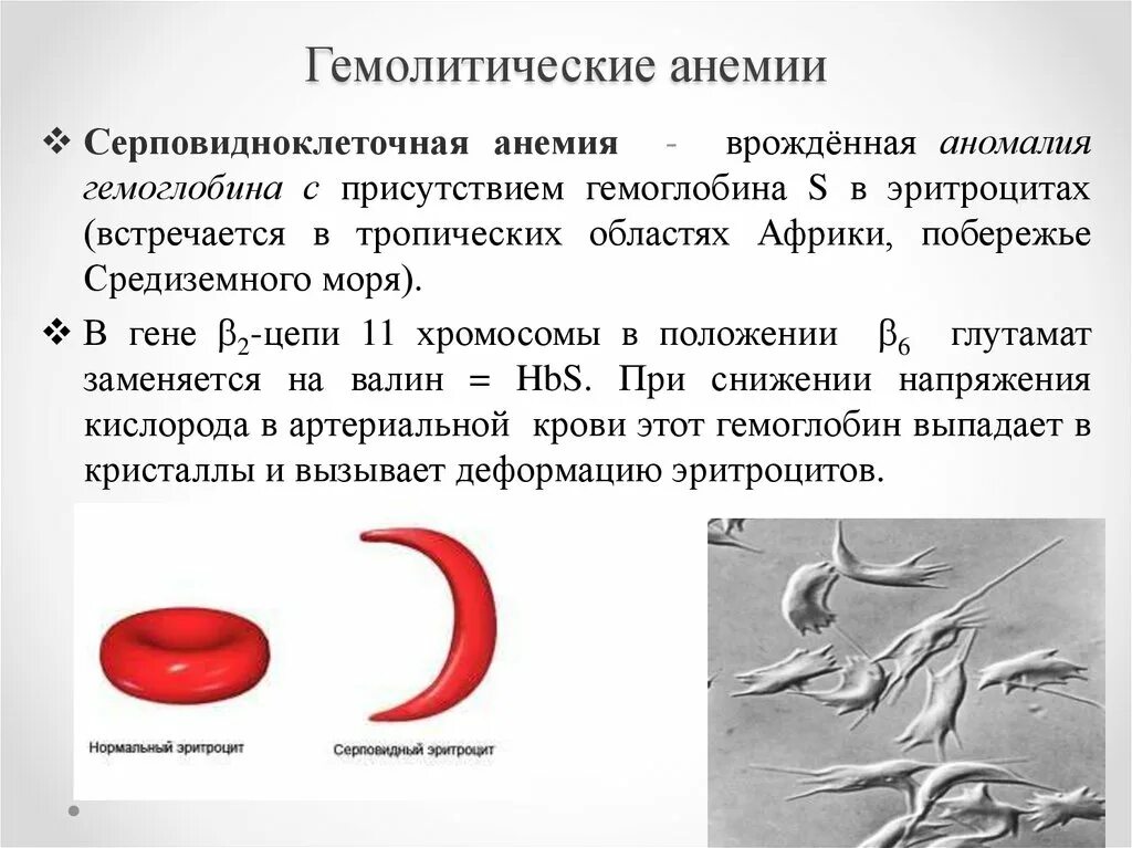 Клинические симптомы гемолитической анемии. Гемолитическая анемия эритроциты и гемоглобин. Серповидно клеточная анемия картина крови. Серповидноклеточная анемия эритроциты.