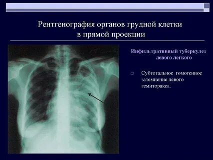 Органов грудной клетки легких