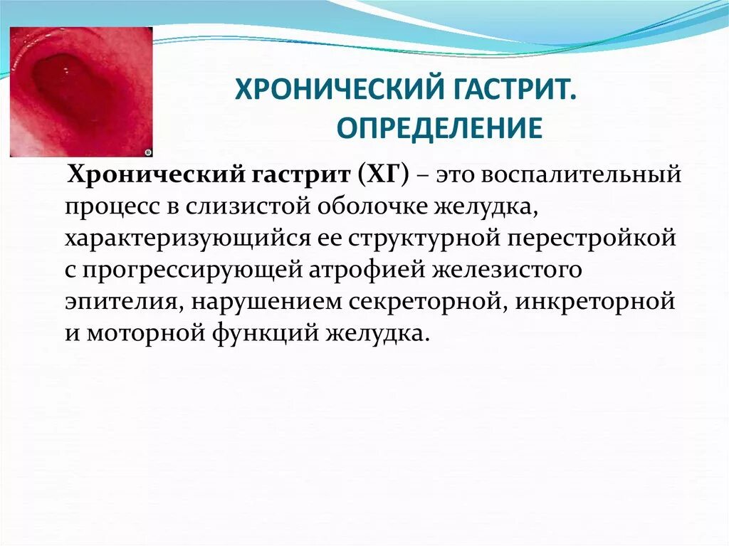 Как восстановить слизистую при гастрите. Интерстициальный хронический гастрит это. Хронический гастрит определение.