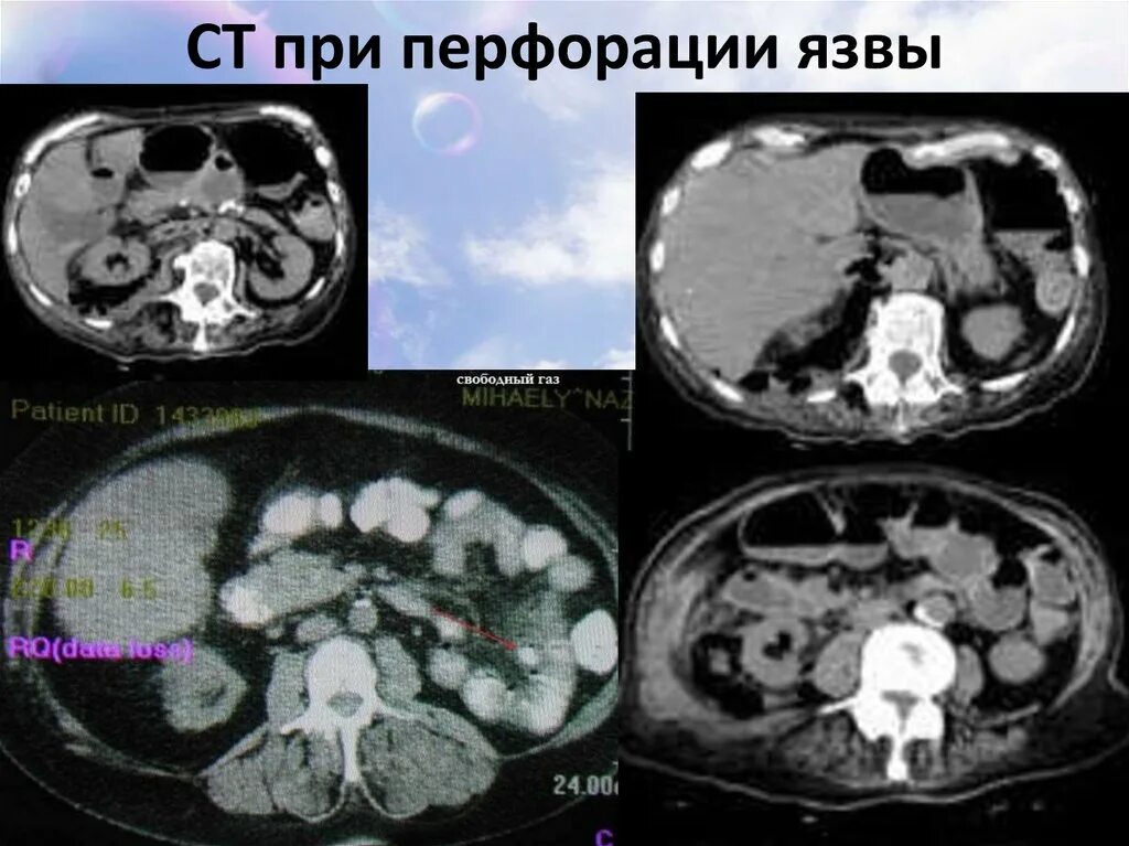 Кт при перфоративной язве. Кт при перфорации язвы желудка. Язва кт