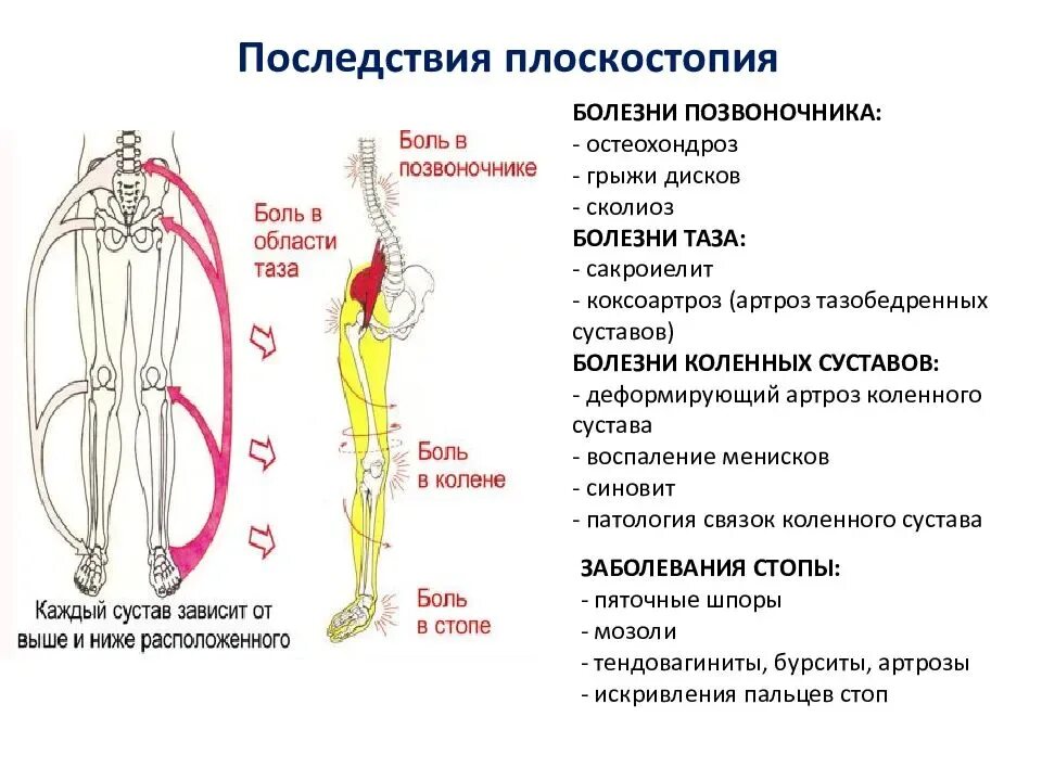 Осложнения плоскостопия. Плоскостопие и остеохондроз. Плоскостопие нагрузка на позвоночник. Мышцы при плоскостопии. Амортизация ног