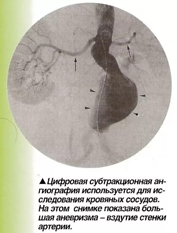 субтракционная ангиография