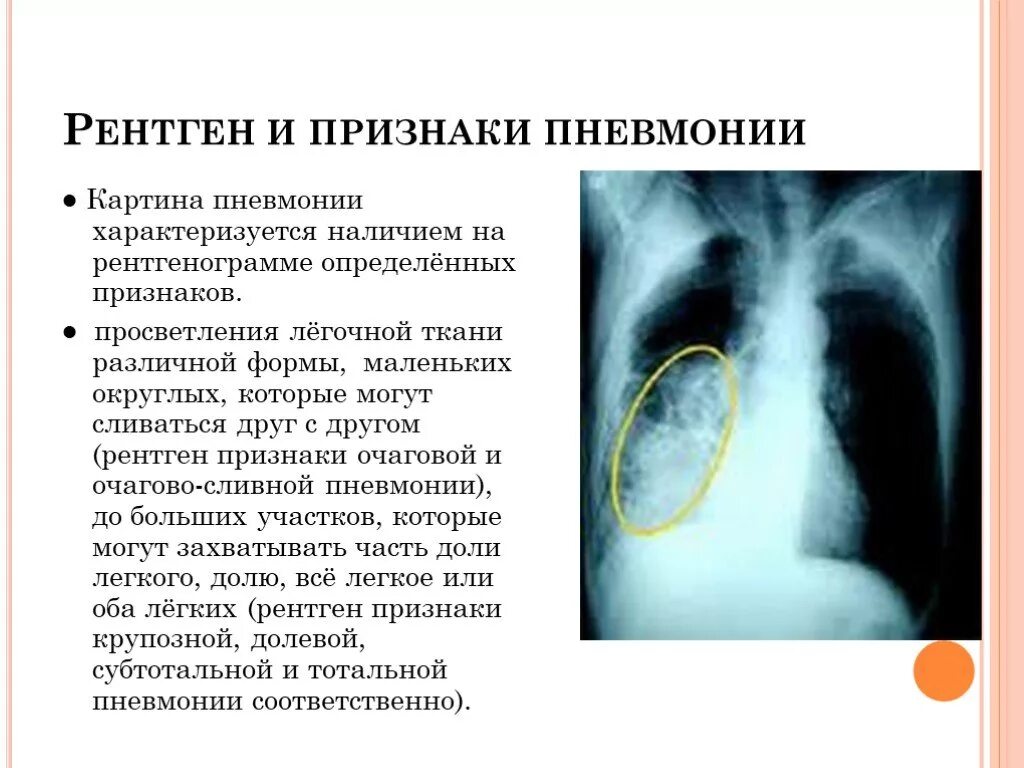 Ковид признаки у взрослых без температуры. Рентген критерии пневмонии. Рентгенография при внебольничной пневмонии. Пневмония симптомы рентген. Рентген легких пневмония протокол.