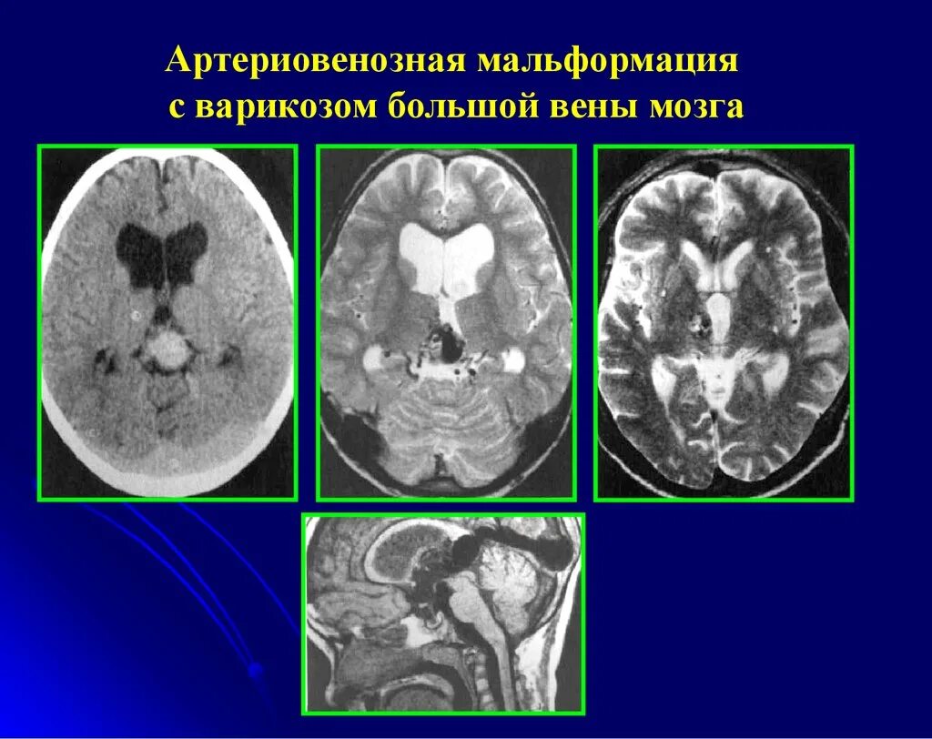 Что такое мальформация головного мозга. Артериовенозная мальформация сосудов головного мозга мрт. мальформация на кт головного мозга. сосудистые мальформации кт мрт. мальформация сосудов головного мозга кт.