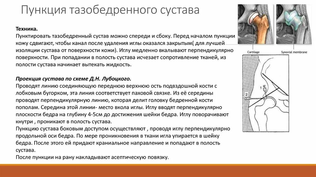 Пункция тазобедренного сустава техника. Точка пункции тазобедренного сустава спереди. Пункция полостей суставов и костей, показания, техника. Внутрисуставная инъекция в тазобедренный сустав техника выполнения. Тазобедренный сустав операция показать