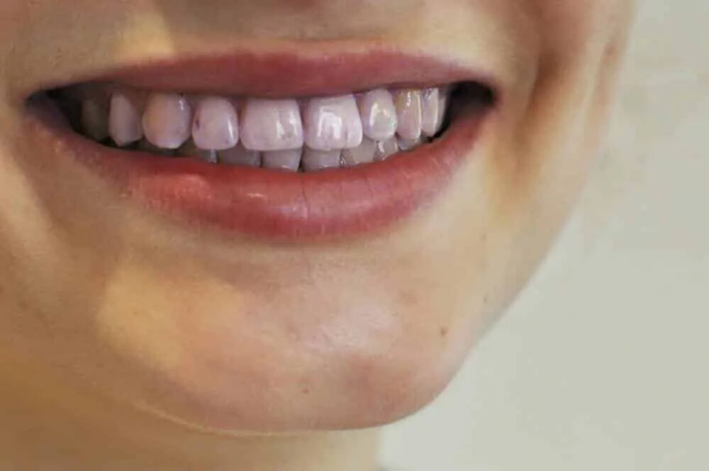 Зубы после 30. Синий зуб.