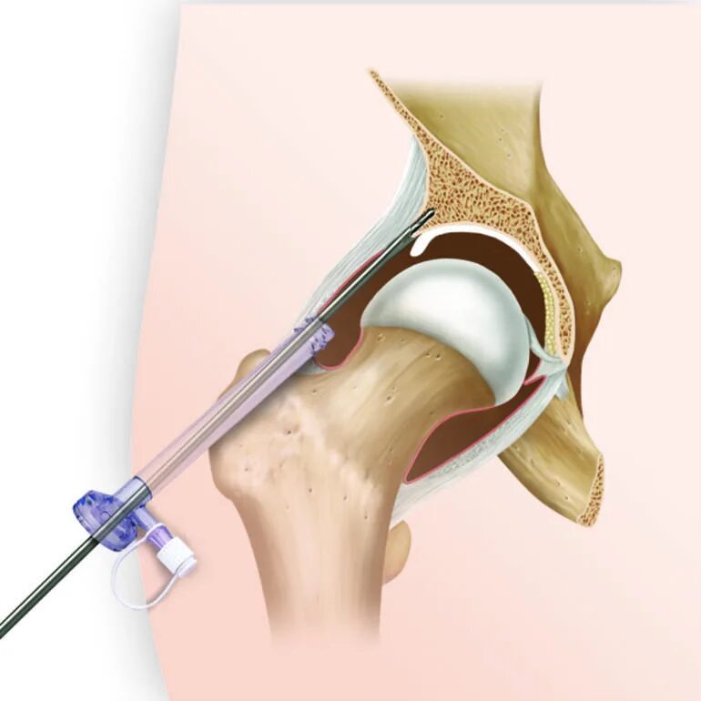 Диагностическая артроскопия тазобедренного сустава. Реактивный синовит тазобедренного сустава. Синовит бедренного сустава. Замена сустава осложнения