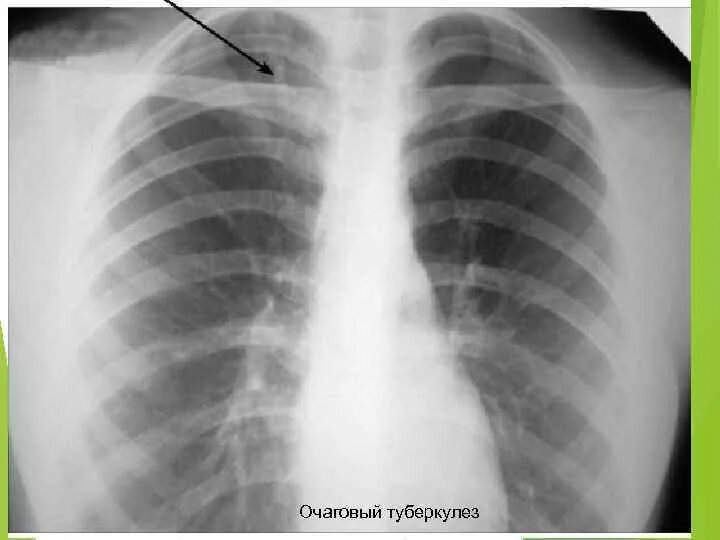 Изменение в верхнем легком. Очаговый туберкулез рентген. Очаговый туберкулёз лёгких рентген. Крупноочаговая пневмония рентген. Фиброзно очаговый туберкулез рентген.