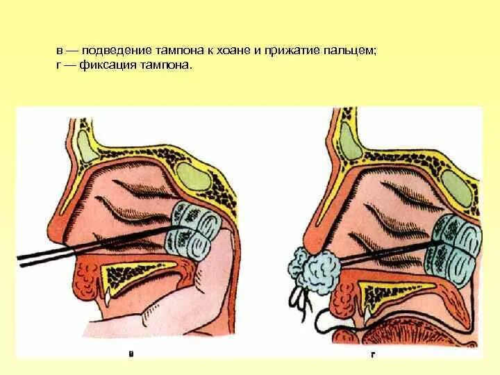 Тампонада носа при носовом кровотечении. Введение турунды в нос.