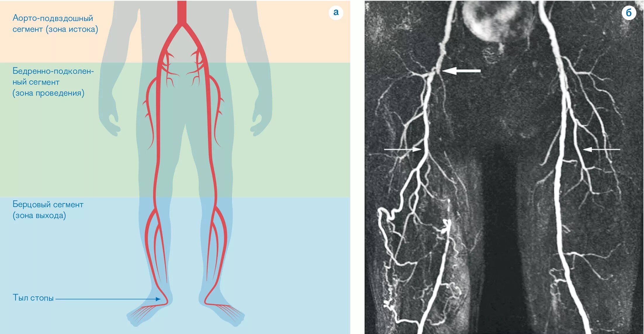Окклюзионные заболевания артерий нижних конечностей. Окклюзия бедренной артерии нижней конечности. Окклюзия бедренной артерии Хан-2а. Окклюзия ПБА нижних конечностей. По дну чего проложена артерия жизни