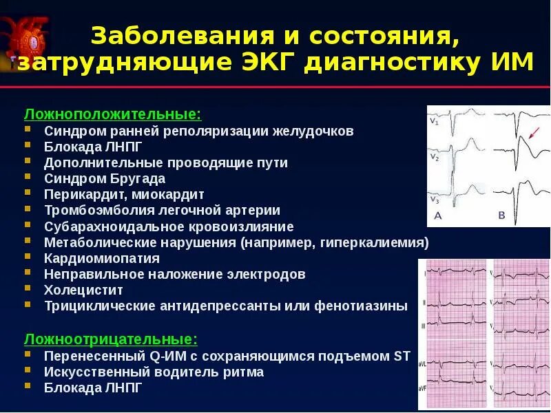 Реполяризация миокарда желудочков ЭКГ. СРРЖ на ЭКГ. Синдром ранней реполяризации миокарда. Реполяризация желудочков на ЭКГ.