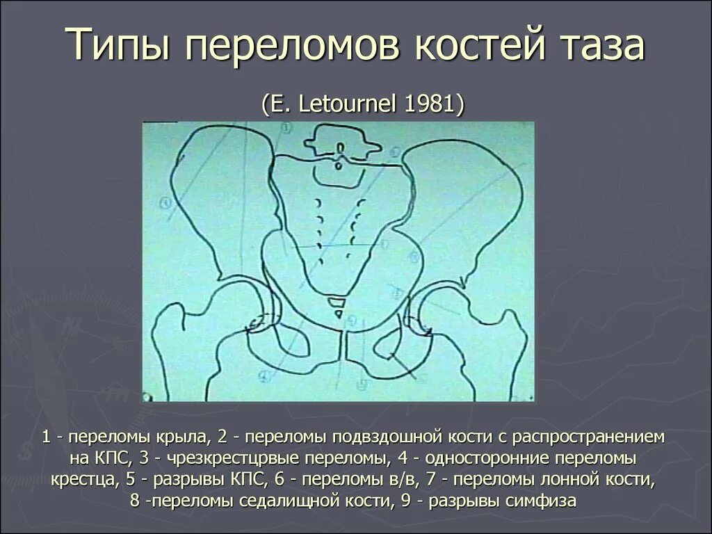 Кт подвздошной кости. Типы переломов костей таза. Перелом подвздошной кости. Перелом крыла подвздошной кости таза. Перелом костей таза кт.