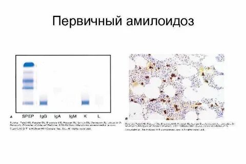 Механизм амилоидоза