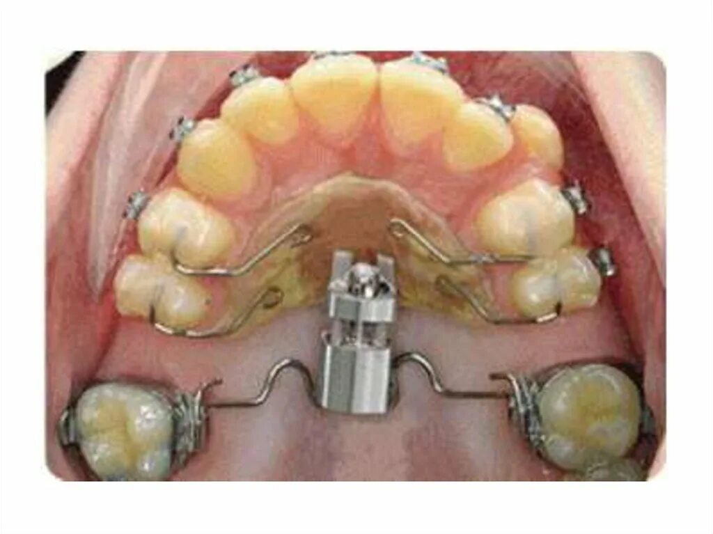 Ортодонтический аппарат Марко Росса. Пластина Марко Росса ортодонтия. Несъемный аппарат Марко Росса. Пендулум ортодонтический аппарат. Аппарат хасса