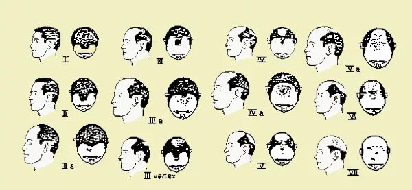 Типы роста волос у мужчин. Формы роста волос на голове у мужчин. Типы роста волос на голове у мужчин. Разновидность роста мужских волос.