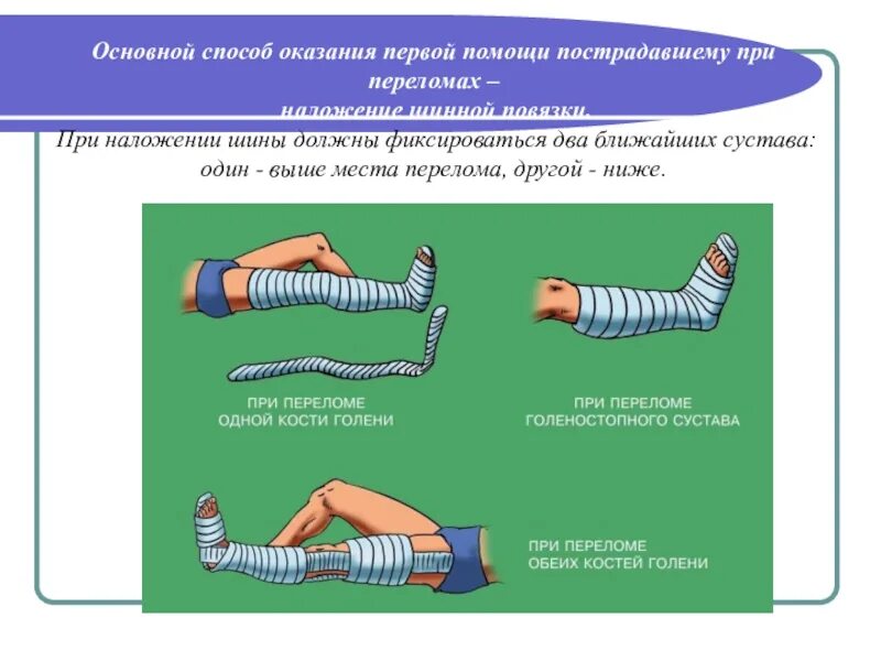 Первая помощь при открытых и закрытых переломах. Переломы костей признаки доврачебная помощь. Порядок оказания первой помощи при переломах костей. Алгоритм оказания первой помощи переломы конечностей. Перелом открытый голени первая помощь перелом.