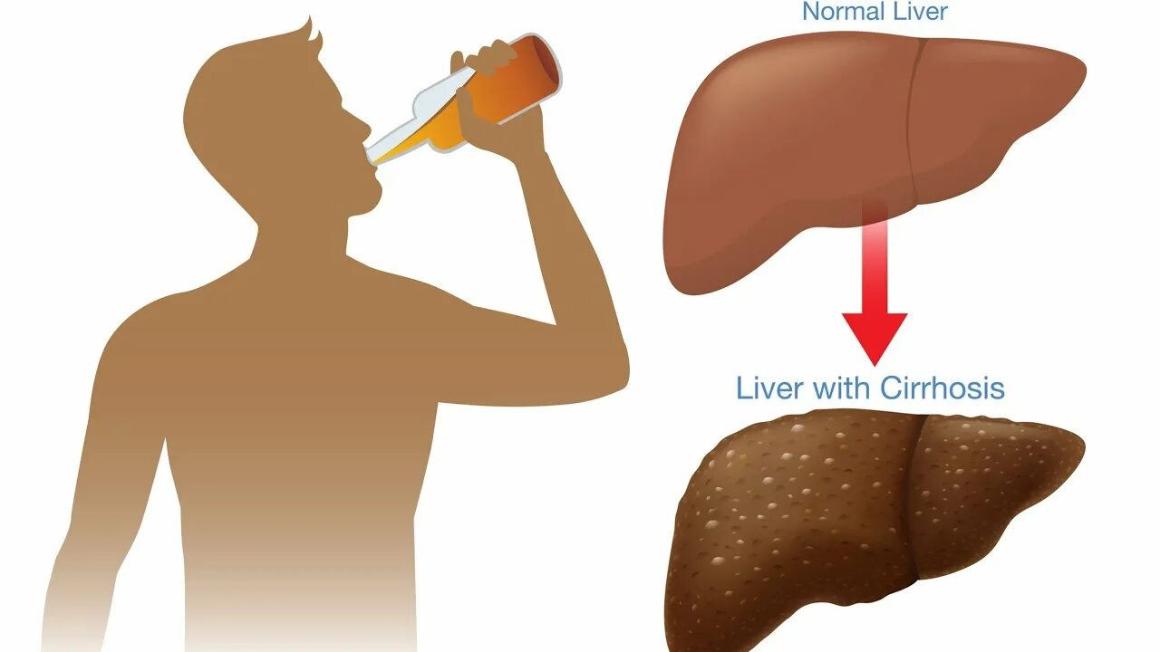 Печень пьющего человека. Гепатоз алкогольный лечение