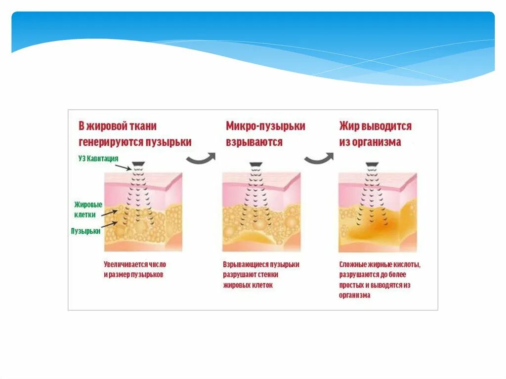 Кавитация аппарат отзывы. Кавитация схема воздействия. Кавитация и RF лифтинг. Ультразвуковая кавитация жировая ткань. Ультразвуковая кавитация схема.