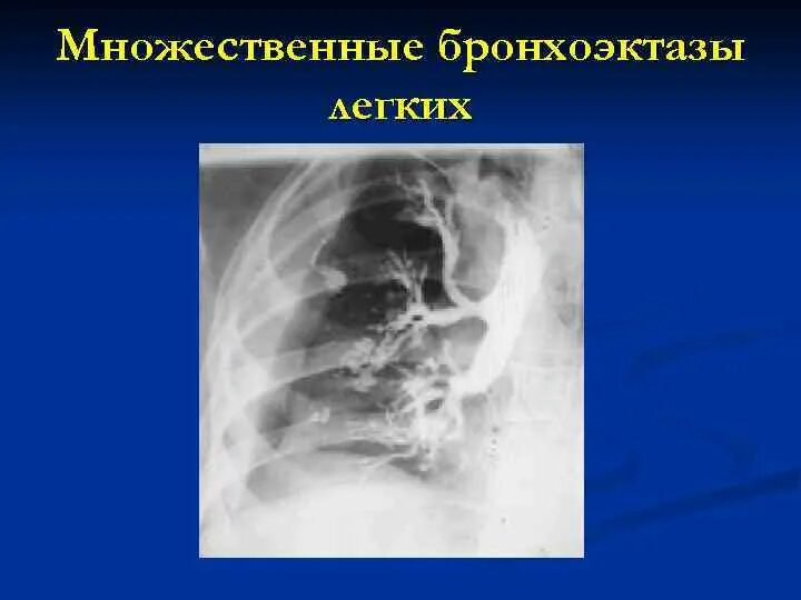 Что такое бронхоэктазы. Множественные бронхоэктазы. блокированный абсцесс легкого это. бронхоэктазы рентген.
