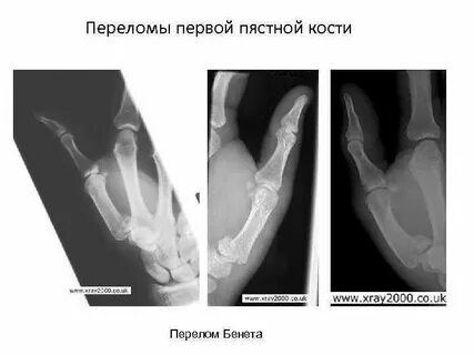 Сломан 1