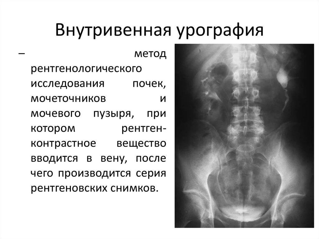 Урография с контрастом. Экскреторная пиелография. внутривенная экскреторная урография. обзорная рентгенография почек урография. инструментальные методы исследования-экскреторная урография.