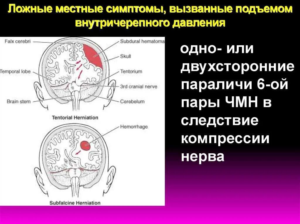 Внутричерепное давление симптомы и лечение у взрослых. Внутричерепное давление симптомы. внутри черепной давления симптомы. черепно мозговое давление. внутреннее черепное давление.