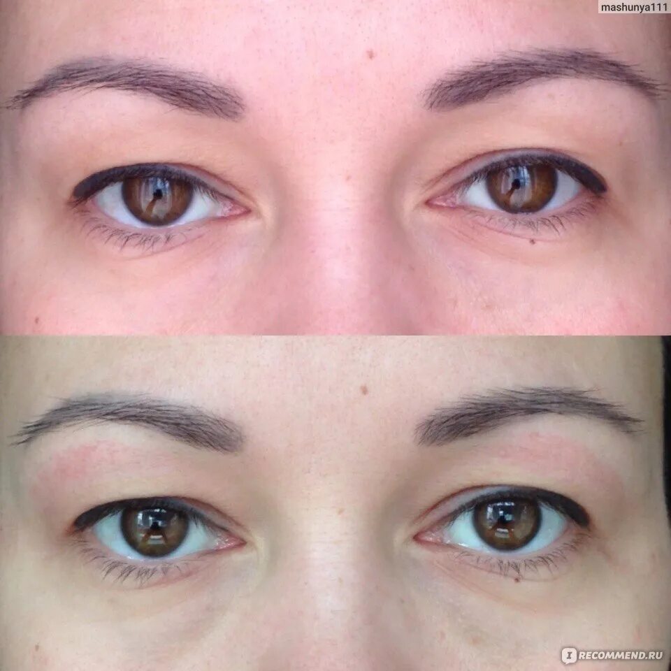 Плазма лайнер. Плазмалайнер кисловодск. Plasma liner аппарат. Плазменное омоложение плазмопен. Плазма лайнер носогубка.