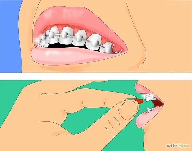 Как уменьшить боль в зубе. Обезболивающее от зубной боли от брекетов. Больно ли надевать брекеты.