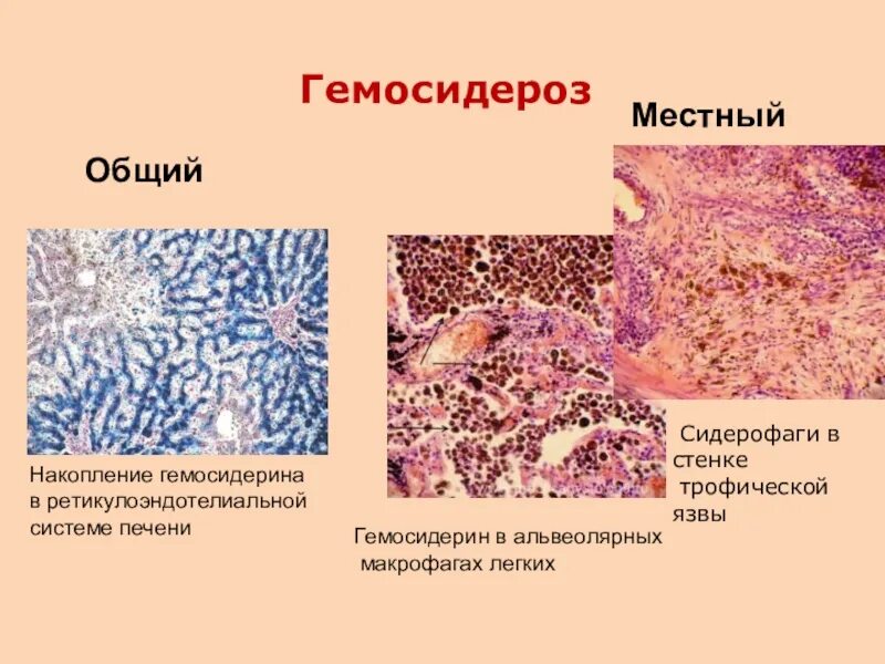 Гемосидероз легкого патологическая анатомия. Гемосидероз печени проявляется. Гемосидероз селезенки препарат. Гемосидероз легкого патанатомия. Железо в макрофагах