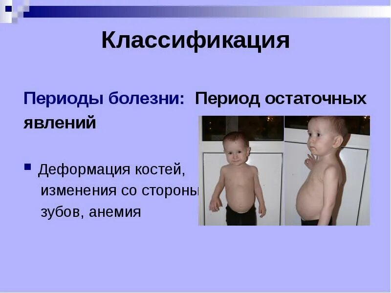 Исследования при рахите. Остаточные явления рахита. Сестринский процесс при рахите. Период остаточных явлений рахита. Наследственные заболевания рахит.