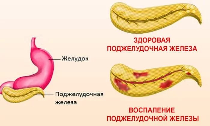 Заболев поджелудочной железы. Воспаление поджелудочной железы рисунок. воспалённая поджелудочная железа. поджелудочная железа здоровая и нездоровая. здоровая поджелудочная железа и больная.