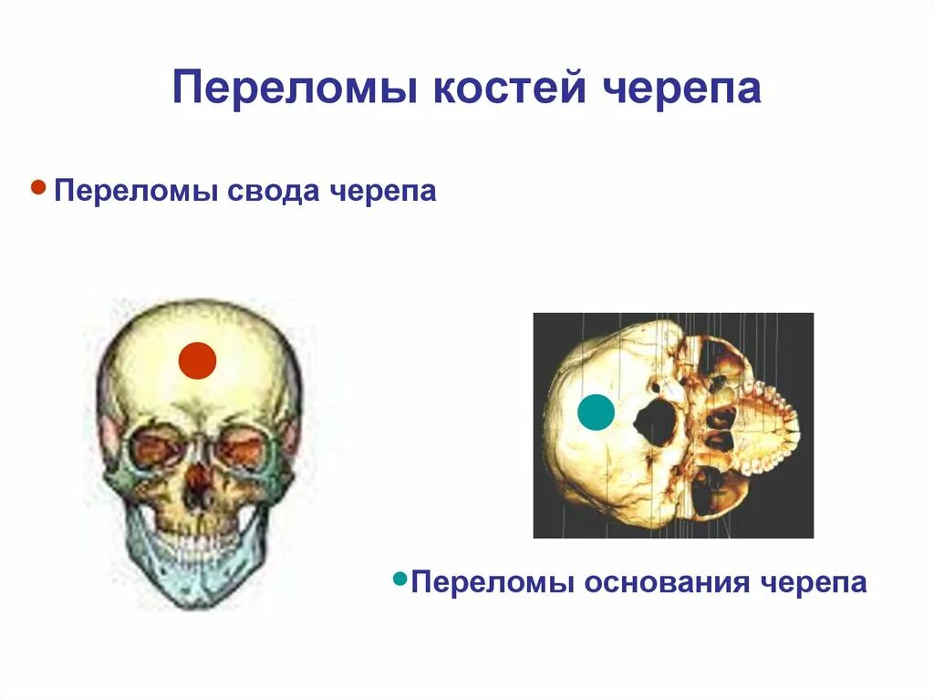 Для перелома основания черепа характерно. Первая помощь при переломе костей свода черепа. Для перелома основания черепа характерен симптом:. Перелом свода основания черепа. Перелом костей основания черепа с повреждением продолговатого мозга.