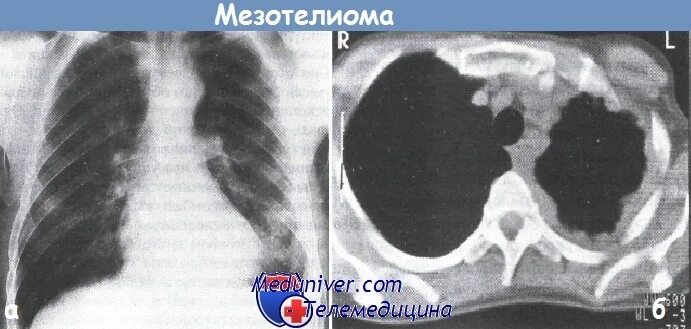 Мезотелиома плевры брюшины и других локализаций. Мезотелиома брюшины кт. Мезотелиома перикарда кт. Перитонеальная мезотелиома. Мезотелиома плевры клинические рекомендации.
