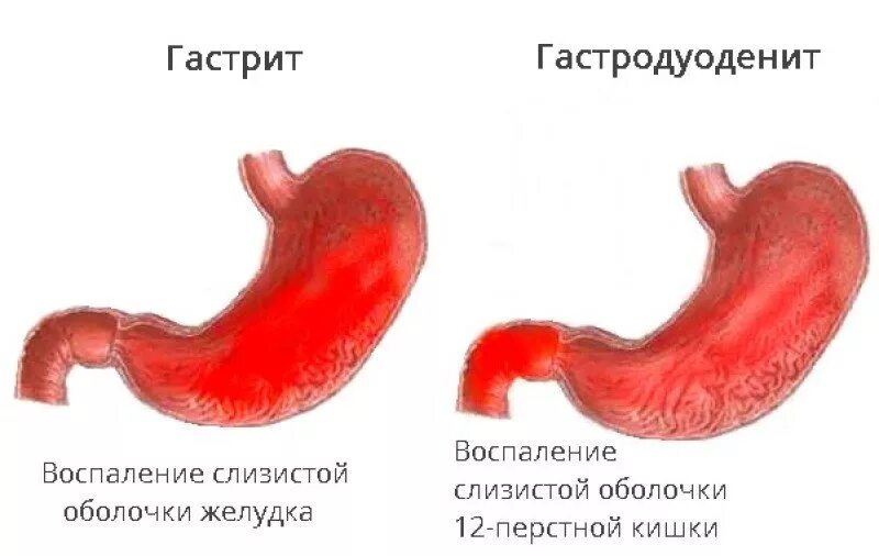 Язвенная болезнь желудка и 12-перстной кишки. Гастрит.. Гастродуоденит 12 перстной кишки. Хронический гастрит и гастродуоденит у детей. Воспаление 12 перстной кишки гастродуоденит.