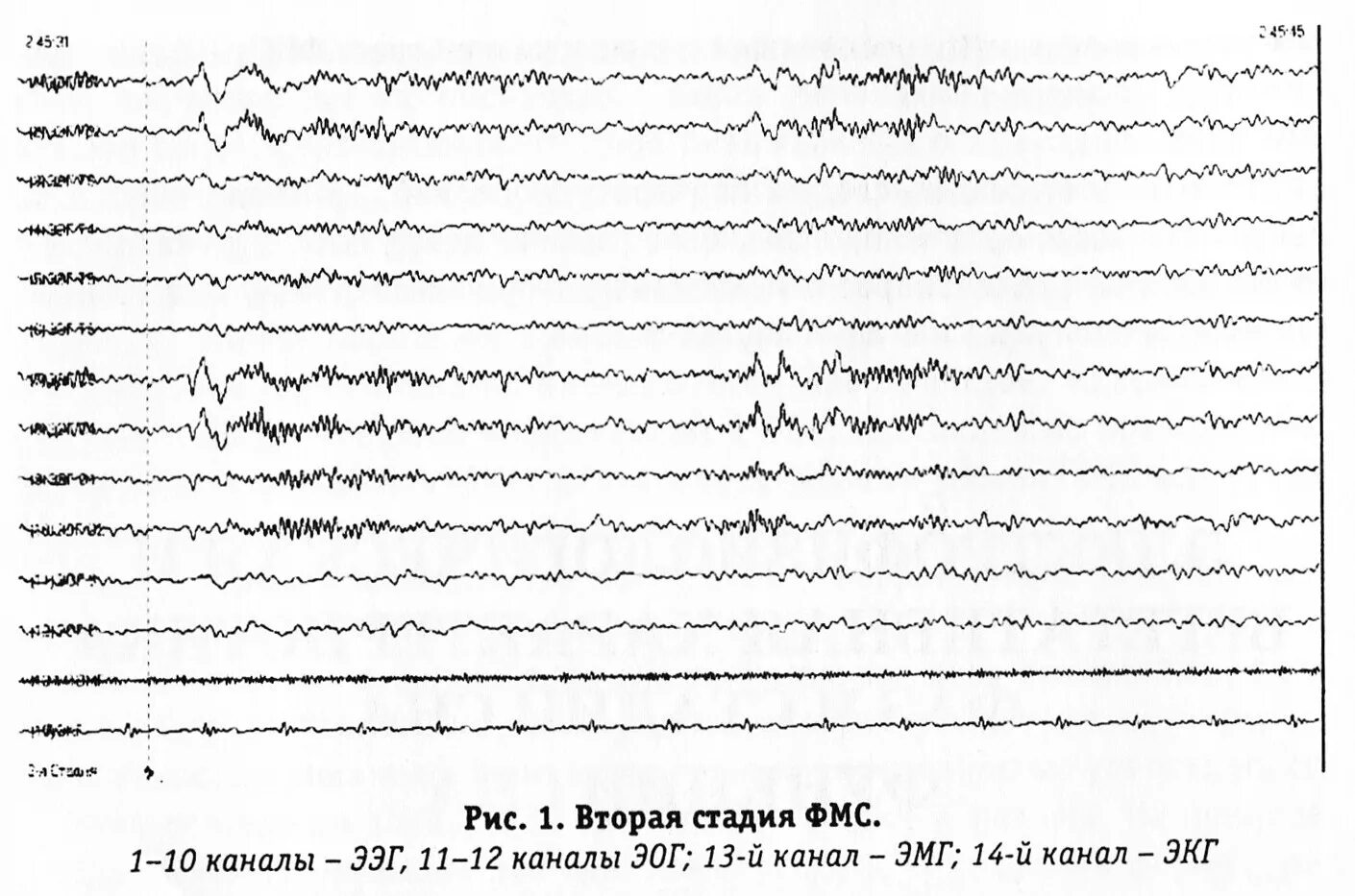 Фазы сна человека диаграмма. Фазы сна фармакология. 3 и 4 стадия сна характеризуется. Сигма ритм на ээг сонные веретена. Стадии сна психофизиология.